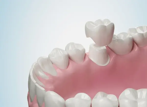 dental crowns in cliffcrest scarborough
