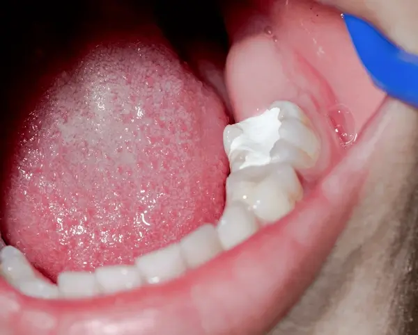 dental fillings in cliffcrest scarborough