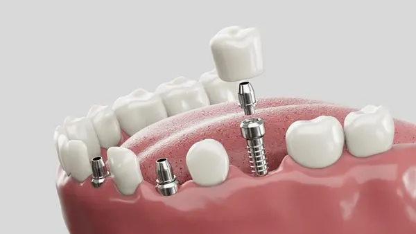 dental implants in cliffcrest scarborough